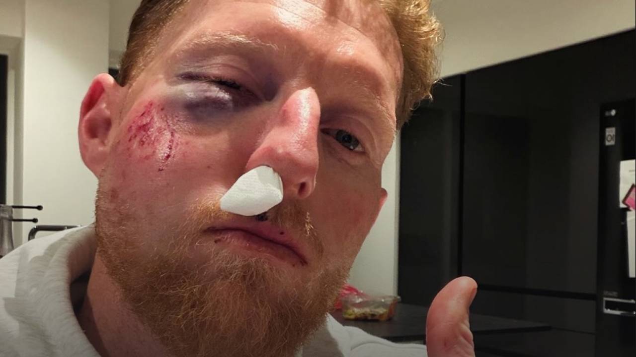 Ben Stokes Par Hua Unexpected Attack: Rehab Ke Dauran Black Eye, But Bazball Ke Captain Ki Spirit Hai Unbroken!
